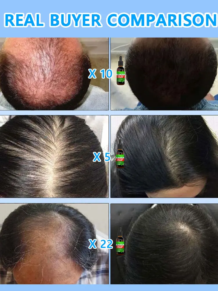 Óleo de crescimento rápido do cabelo para perda de cabelo, seborreica hereditária, promotor, essência, produtos de segurança